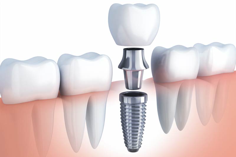 Implants Dentist in Reno