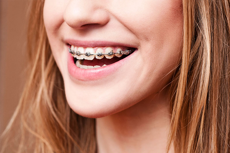 Orthodontics in Reno